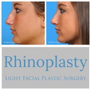 Rhinoplasty before and after treatment