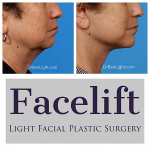 Facelift Before and after treatment