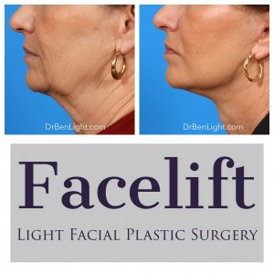 Facelift Before and after treatment