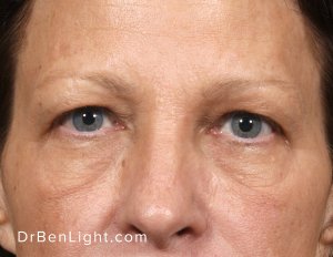 Upper Blepharoplasty Before Treatment