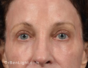 Upper Blepharoplasty After Treatment