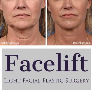 Facelift Before and after treatment