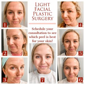 Before and after treatment at Light Facial Plastic Surgery