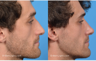 Rhinoplasty Before and After Treatment