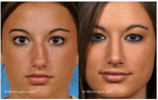 Rhinoplasty Before and After Treatment