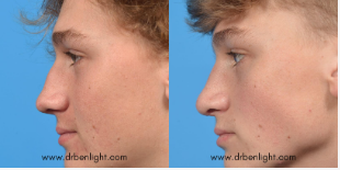 Rhinoplasty Before and After Treatment