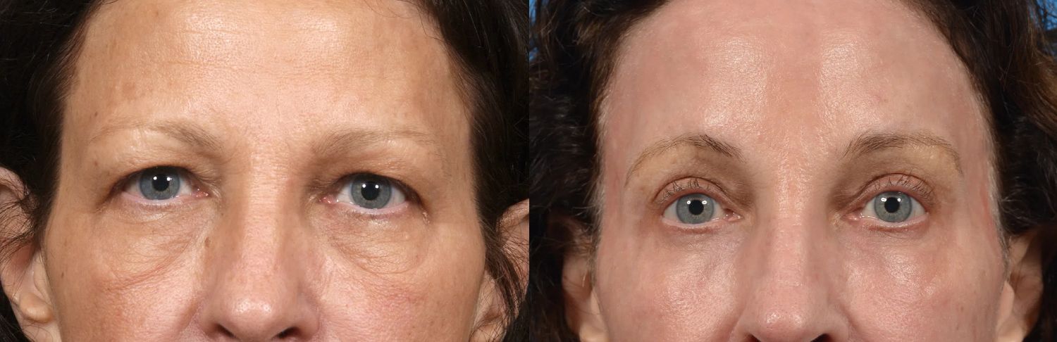 Browlift before and after treatment