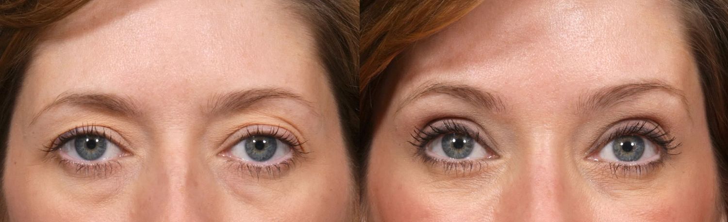 Browlift before and after treatment