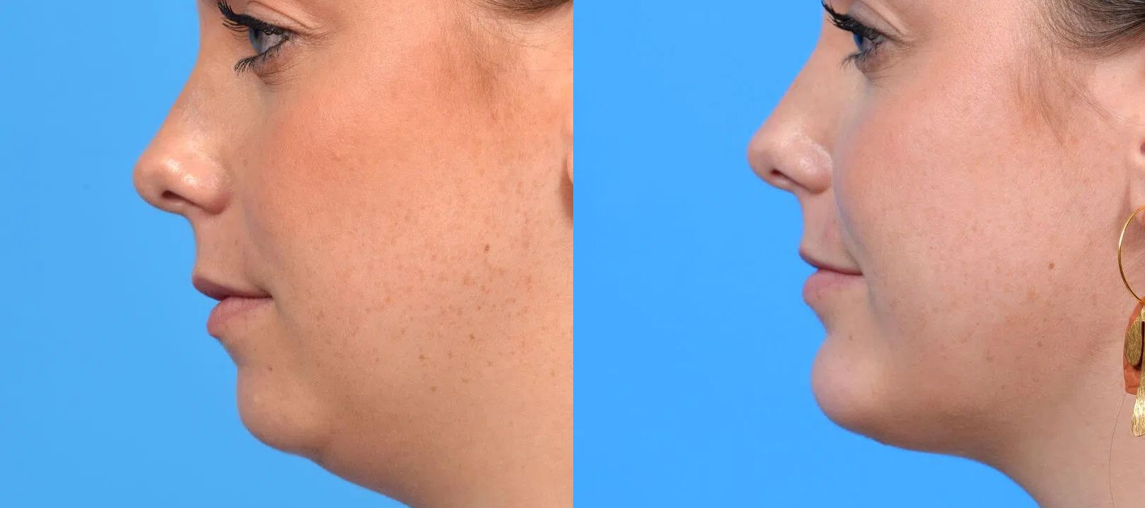 Chin Implant before and after treatment