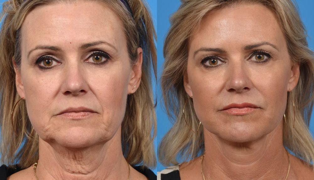 Facelift before and after treatment