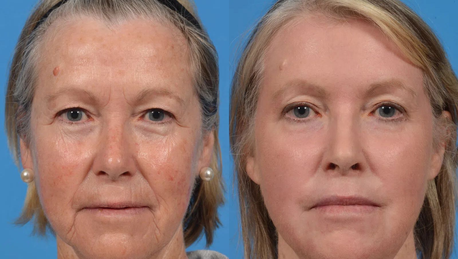 Laser Facial Rejuvenation before and after treatment