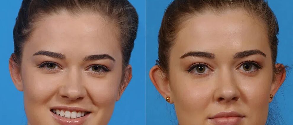 Otoplasty before and after treatment