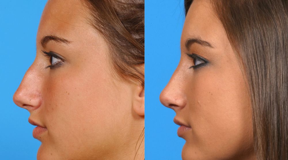 Rhinoplasty Before and after Treatment