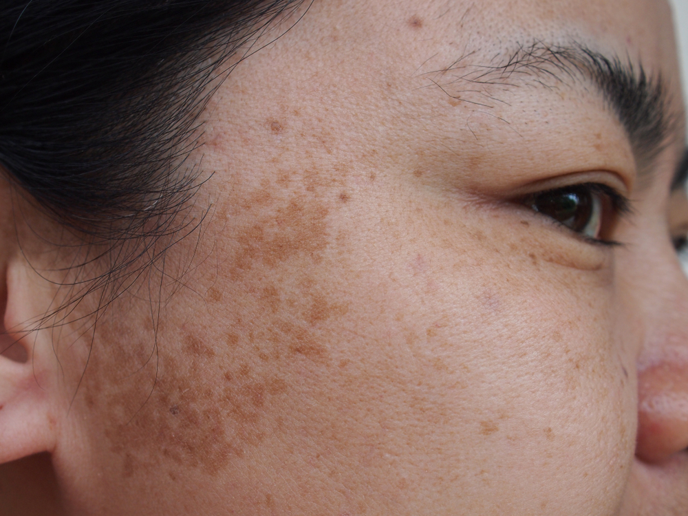 Dark Spots on women's face